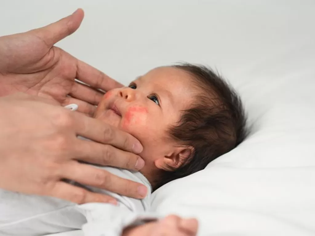 ilustrasi penyakit kulit pada bayi (Pinterest.com/momjunction.com)