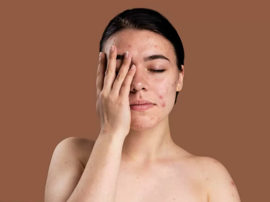 ilustrasi wanita dengan kulit berjerawat (FREEPIK)