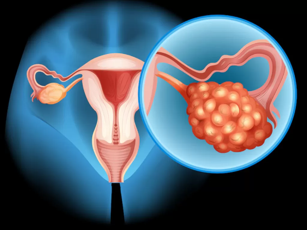 Ilustrasi kanker ovarium. (Freepik/brgfx)