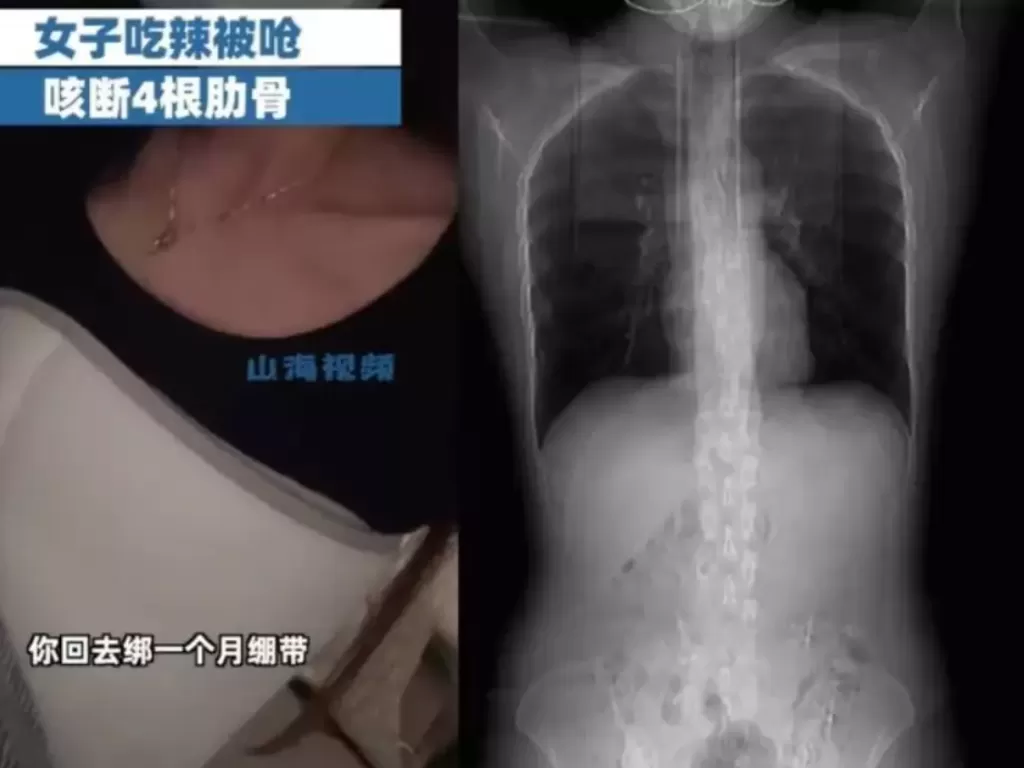 Tulang rusuk wanita ini patah setelah batuk. (Weibo)