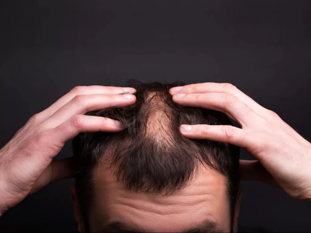 Ilustrasi rambut rontok pada pria. (FREEPIK)