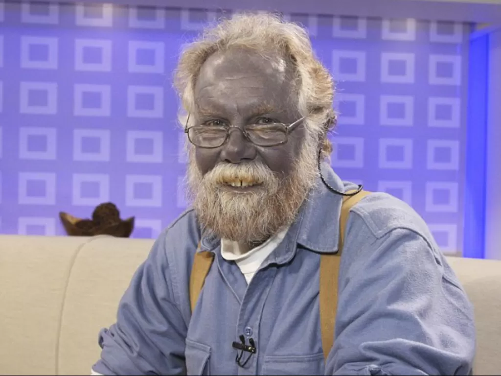 Paul Karason, pria yang dijuluki ‘Papa Smurf’ karena kulitnya biru (Daily Mail)