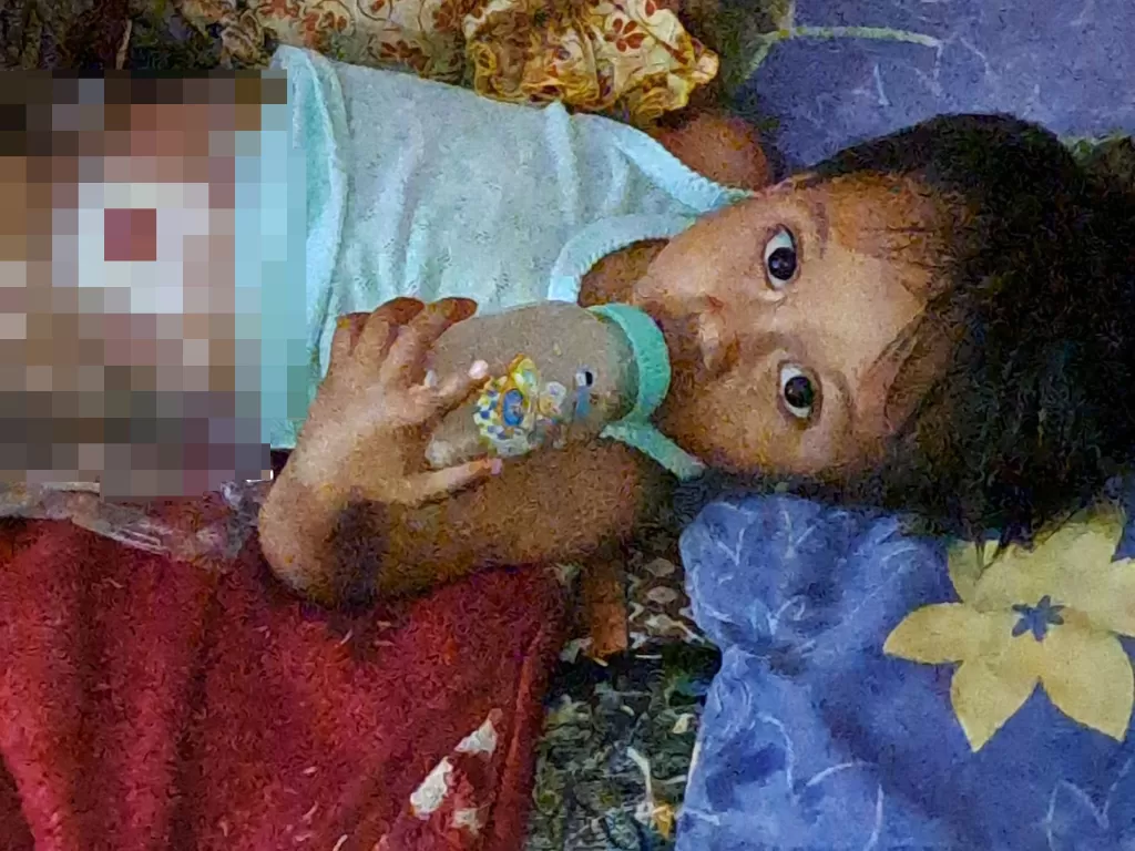 Almeera, balita yang mengidap penyakit langka tapi ditinggalkan kedua orang tuanya. (Dok. Yayasan Rumah Asuh Indonesia)
