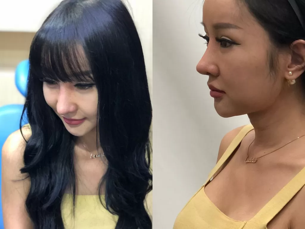 Lucinta Luna pamer hidung baru usai oplas (Instagram/lucintaluna_manjalita)