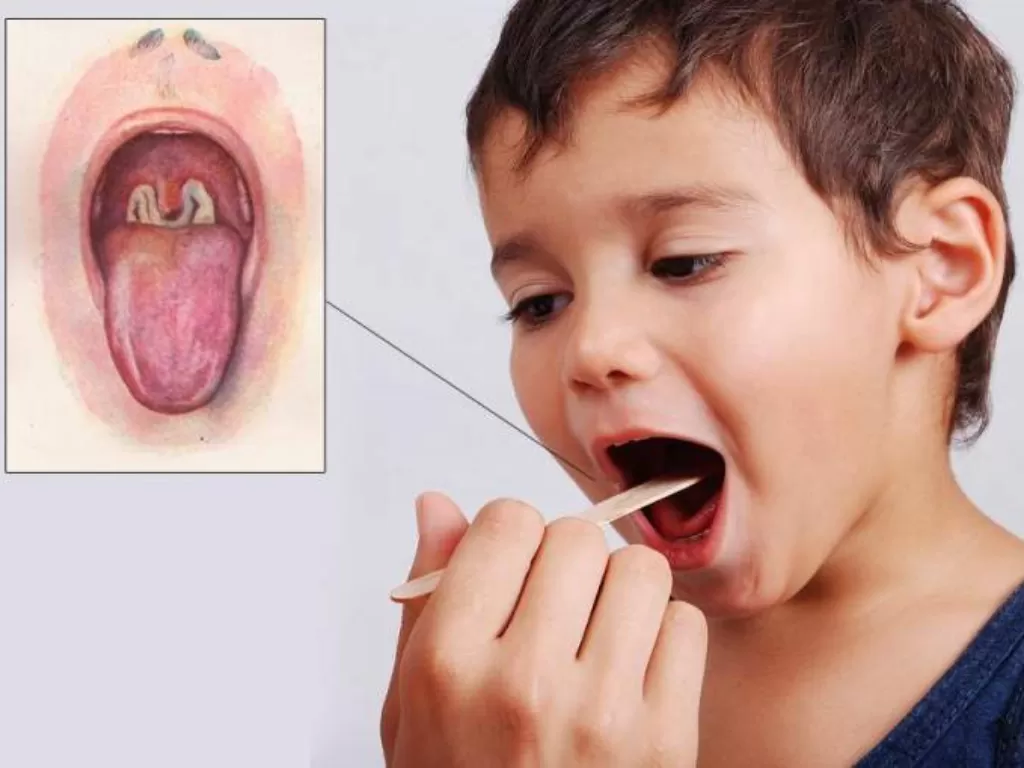 Ilustrasi pemeriksaan pada anak yang terindikasi difteri. (Qsota)