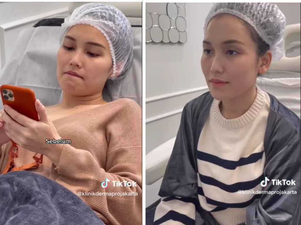 Penampakan Bentuk Hidung Ayu Ting Ting Usai Tanam Benang (TikTok/@klinikdermaprojakarta)