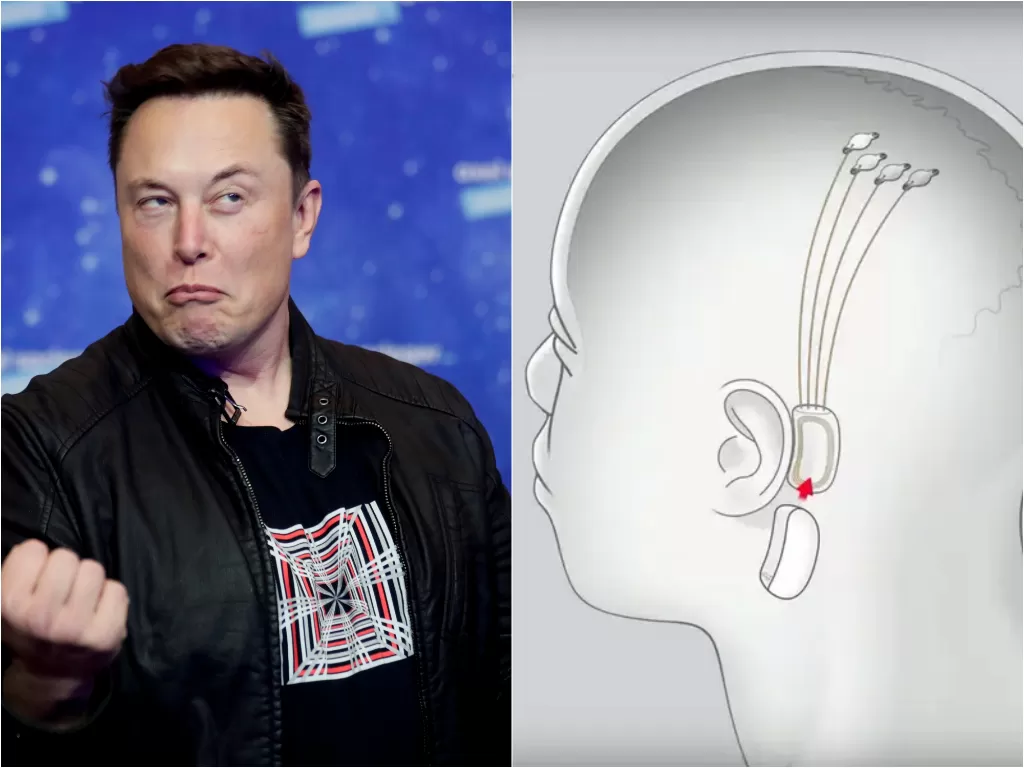 Perusahaan Elon Musk, Neuralink dapat izin tanam chip di otak manusia. (REUTERS/Hannibal Hanschke/Pool/YouTube/Neuralink)