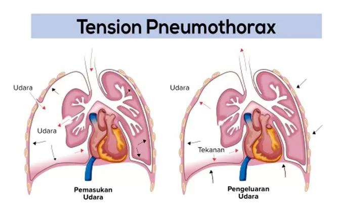 Tension Pneumothorax Simulator SKU 150-1800  Nasco Healthcare