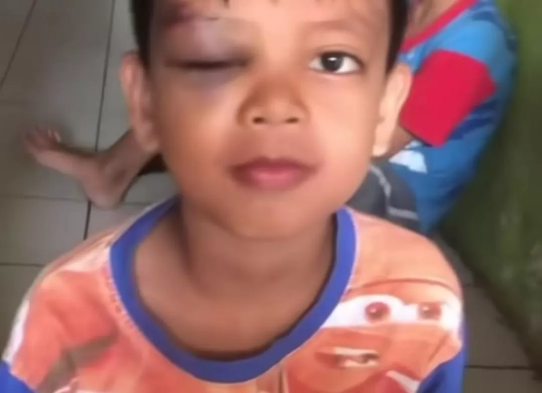 Anak laki-laki korban lato-lato hingga mata bengkak (Dok tangkapan layar)