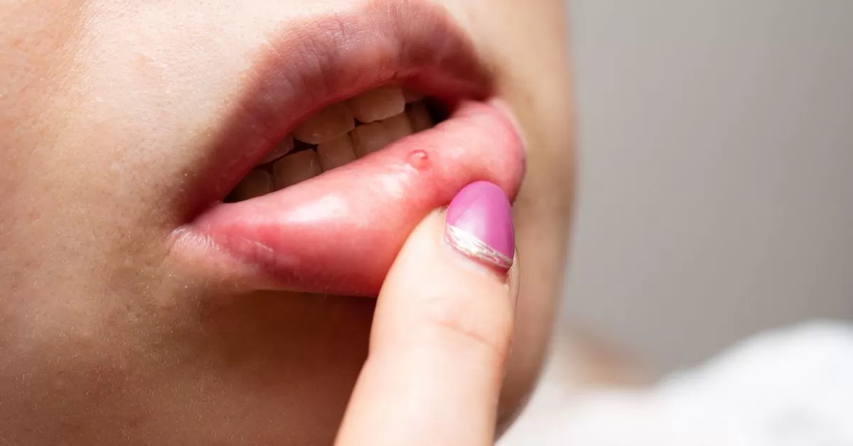 5 Cara Mengobati Sariawan di Mulut Tanpa Obat (canva by Hakase_)