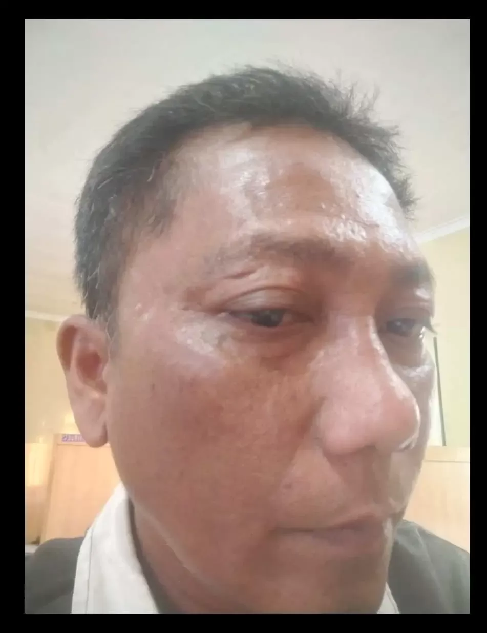 DPD PJS Sumut Desak Polisi Tangkap Pelaku Penganiayaan Wartawan di Lokasi Galian C Ilegal Toba