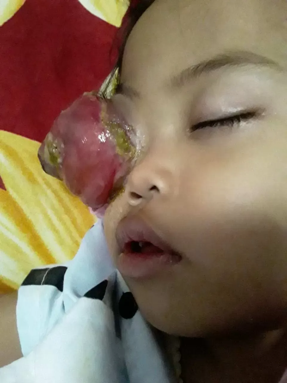 Karina Putri, Pejuang Kecil Melawan Kanker Mata, Butuh Uluran Tangan