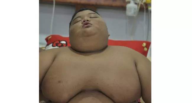 Riski Rahmat Ramadhon pasien yang mengalami obesitas (kegemukan) yang dirawat di RSMH Palembang. 