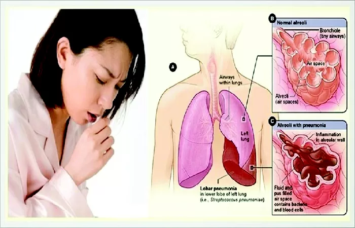 Tuberkulosis : Penyakit Mematikan yang Masih Menghantui Indonesia