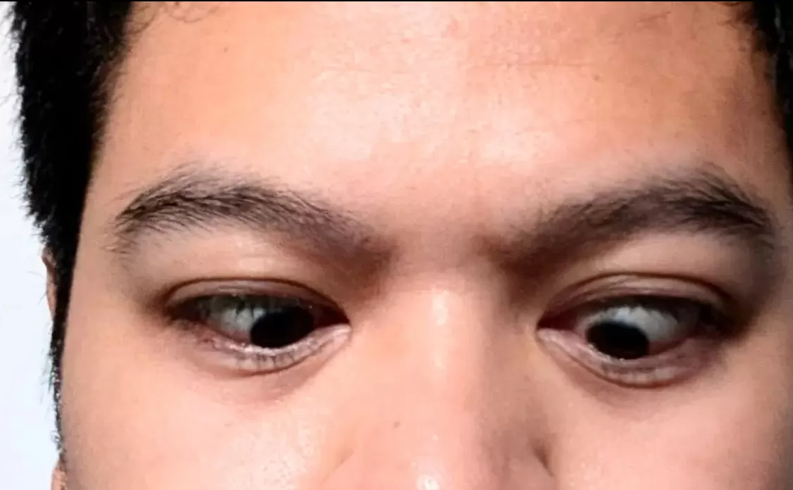  9 Gejala Mata Juling alias Strabismus, Apa Penyebab dan Bagaimana Cara Menanganinya? ( Foto: Liputan6.com/Ade Nasihudin.)