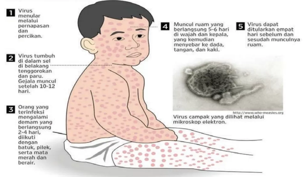 Infeksi campak. (Sumber: CDCP WHO) 