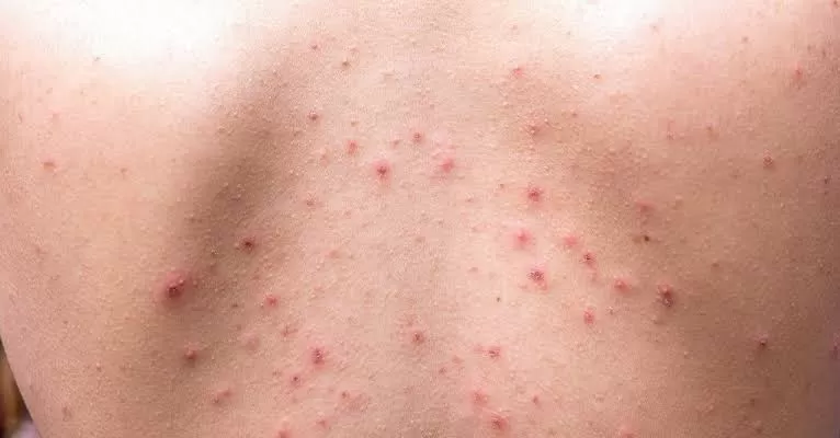 Gambar jerawat punggung (Tirto)