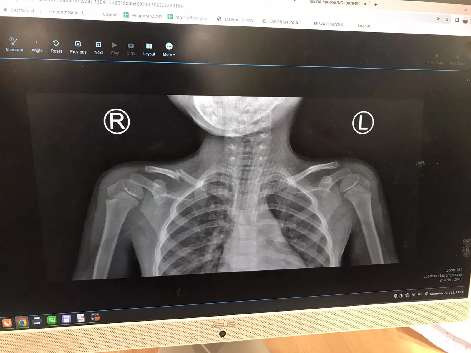 Hasil rontgen patah tulang selangka pada anak (Dokumentasi tim Surat Dokter)