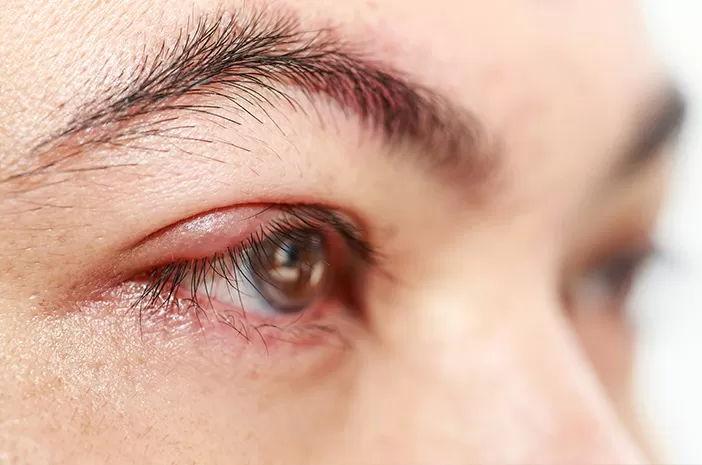 Ilustrasi mata bintitan (halodoc)