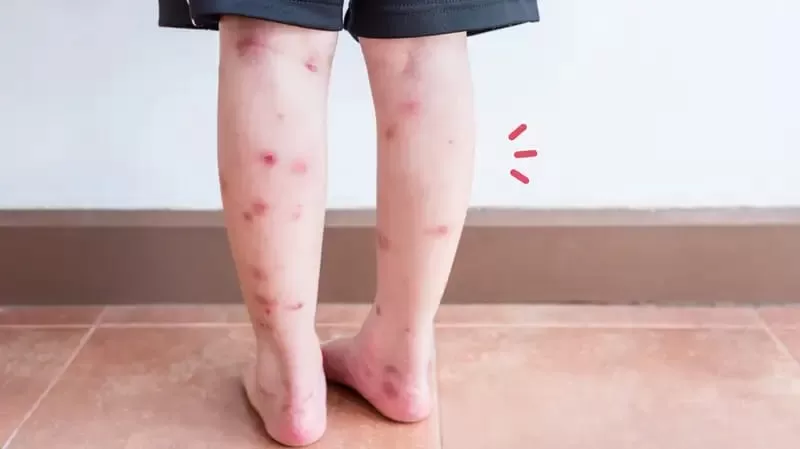 Ilustrasi bekas luka bintik bintik di kaki (Unsplash)