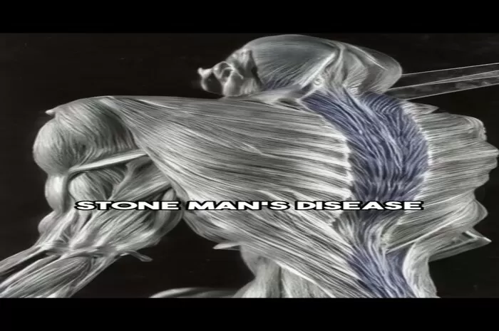 Ilustrasi Stone Man Syndrome  (tiktok/@anonymousdoctoryt)