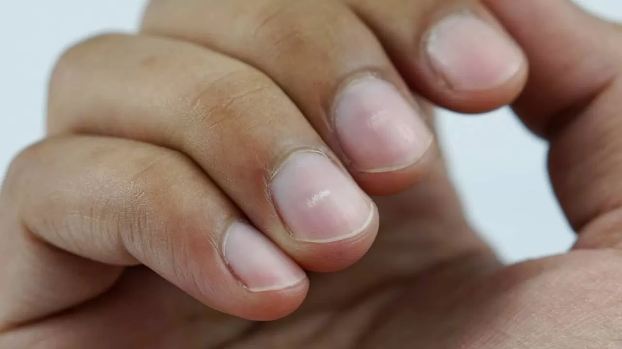 putih-putih pada kuku  (Luna)