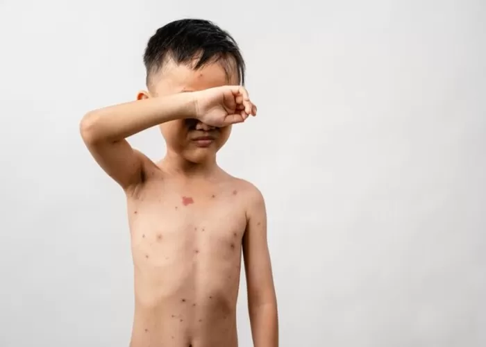 Ilustrasi Mpox pada anak