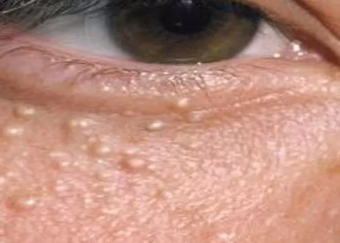 Milia atau bintik susu