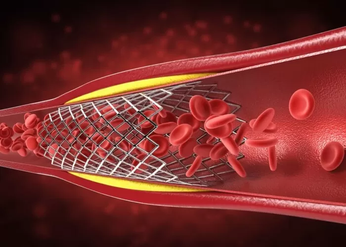 Gejala pembuluh darah tersumbat