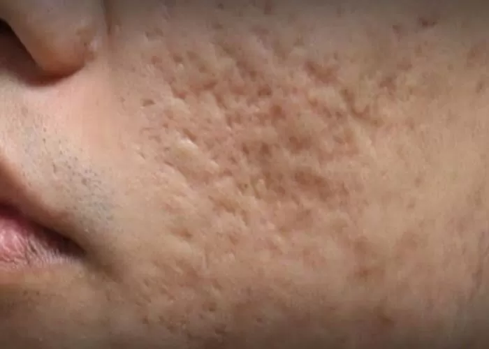 Ilustrasi bopeng karena bekas jerawat - ramai Doktif sebut rawat pasien COVID-19 bikin bopeng