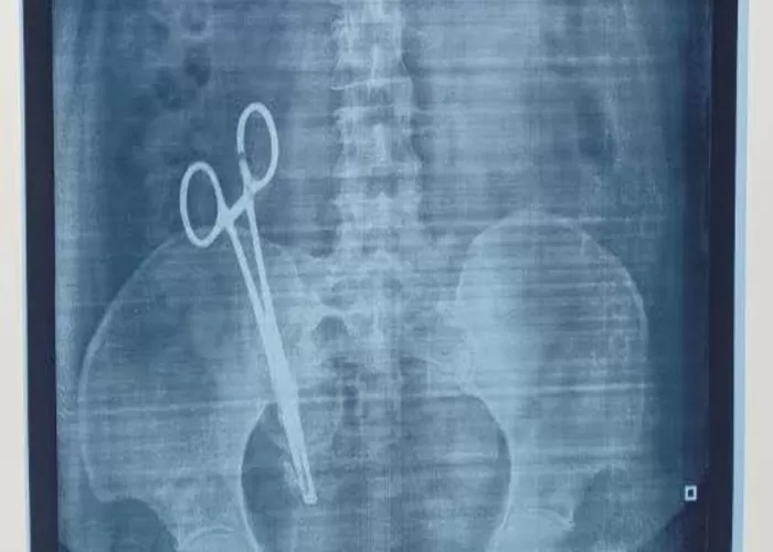 Pisau bedah tertinggal dalam perut seorang wanita selama 17 tahun