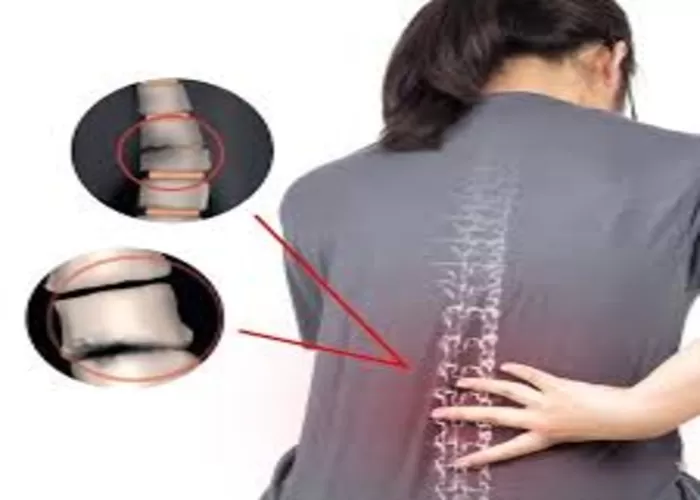 Tuberkolosis tulang atau TBC tulang