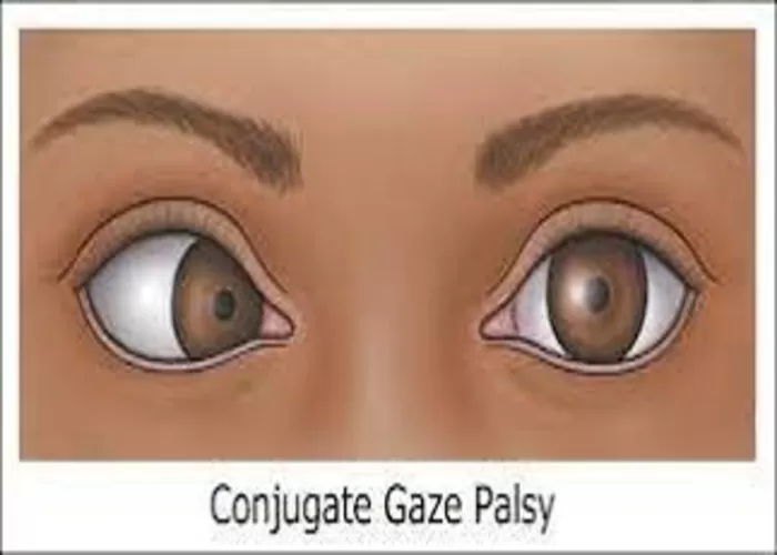Conjugate gaze palsy