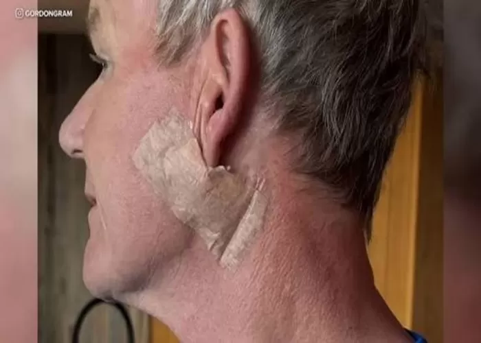 Gordon Ramsay jalani perawatan kanker kulit