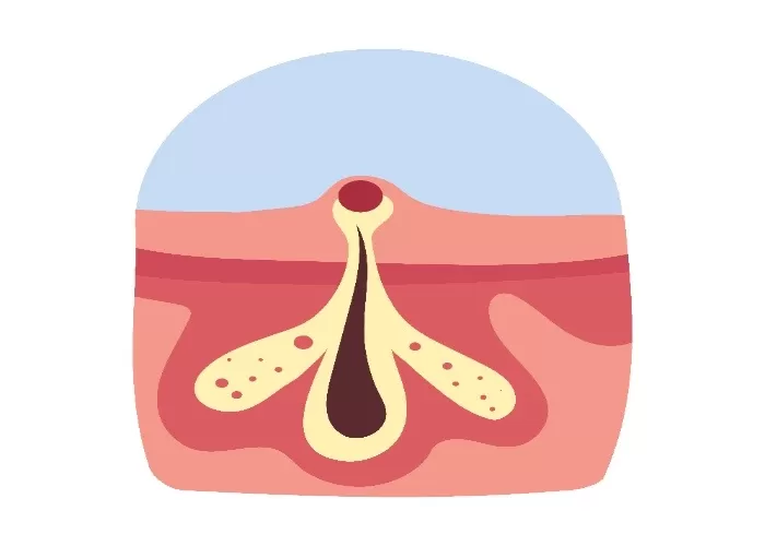 Begini cara mengatasi ingrown