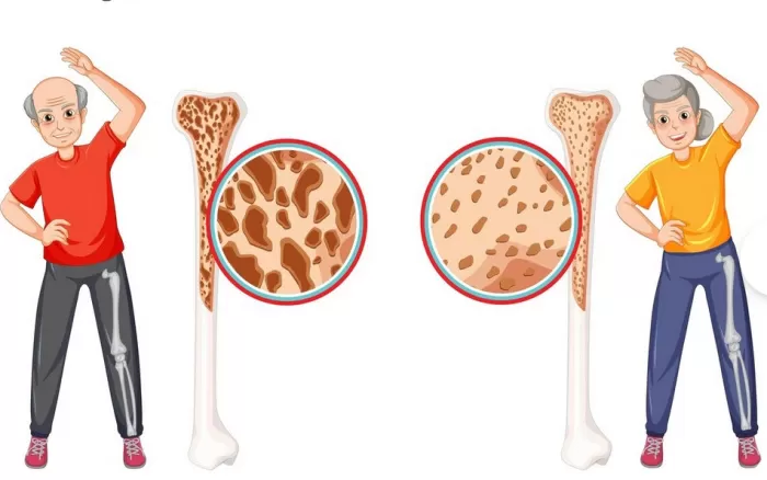 Kenali Ciri dan Bahaya Osteoporosis Sebelum Terlambat (Freepik)