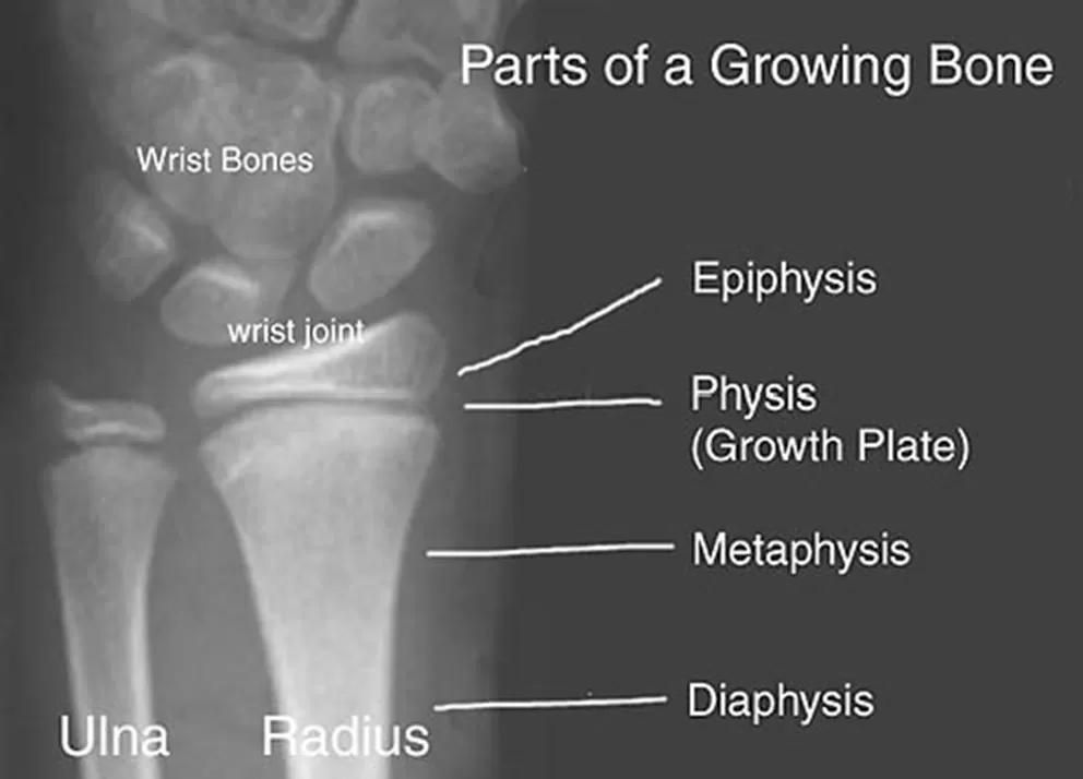 Posisi lempeng epifisis. (ct-ortho.com)