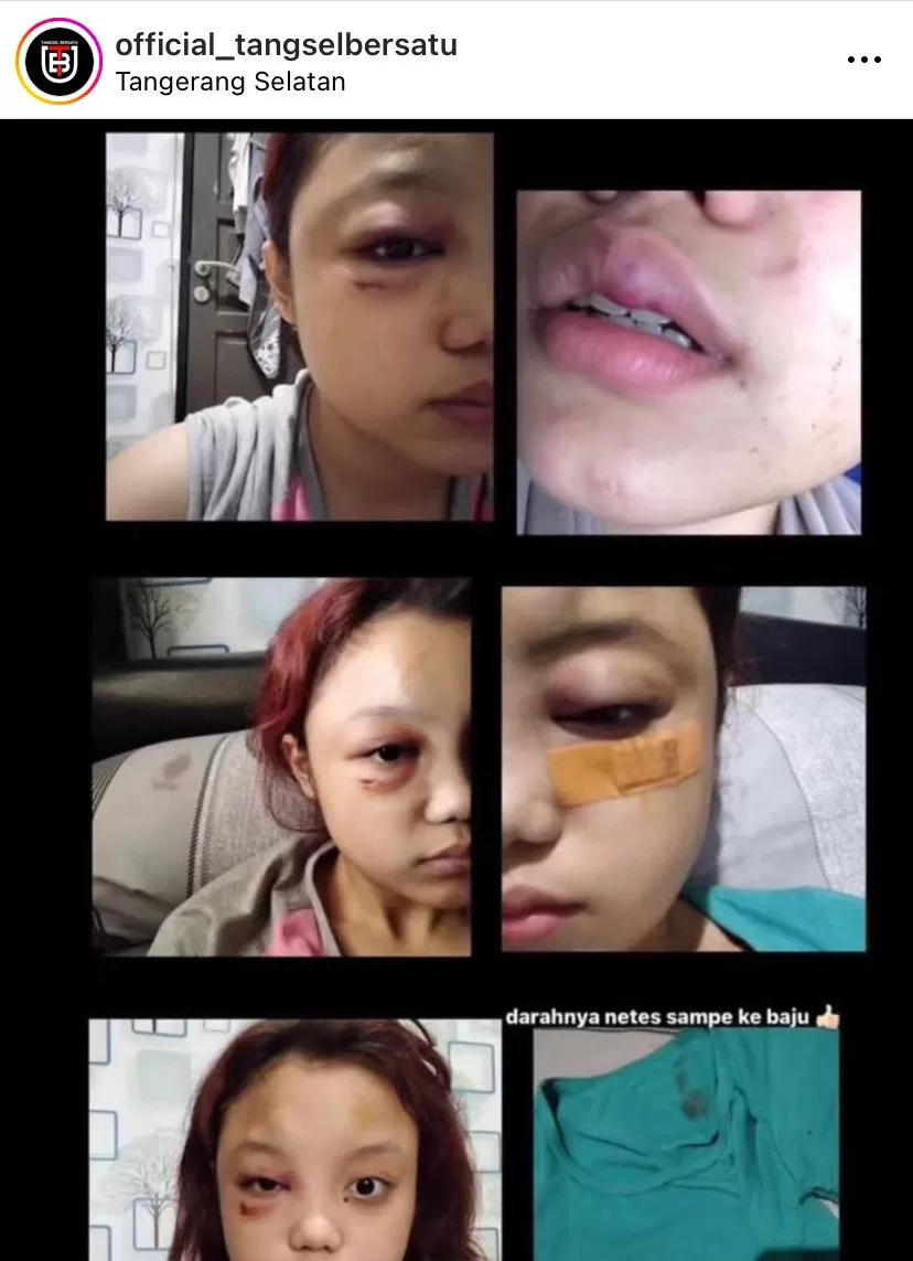 HA (20), korban penganiayaan oleh pacarnya, Alfarizi Aziz (19). (Instagram / @official_tangselbersatu)