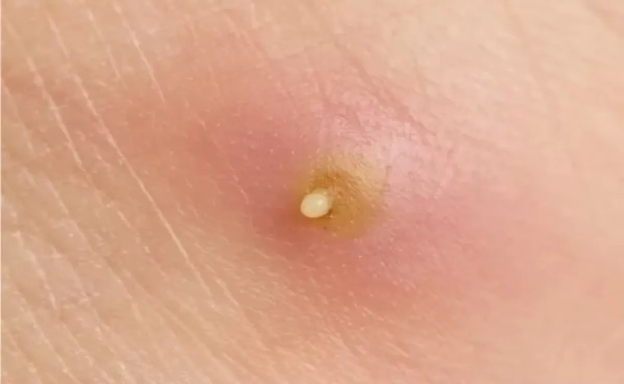 cara mengobati bisul (alodokter) (puspita )