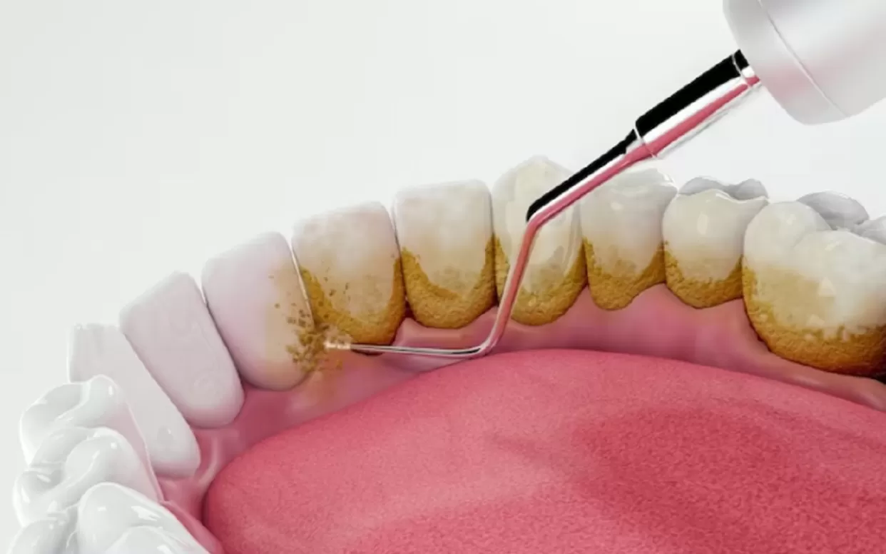 lima cara ampuh menghilangkan karang gigi (freepik) (puspita)