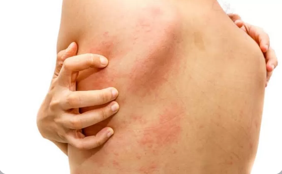 mengenali penyakit Stevens Johnson Syndrome atau SJS (hellosehat) (puspita )