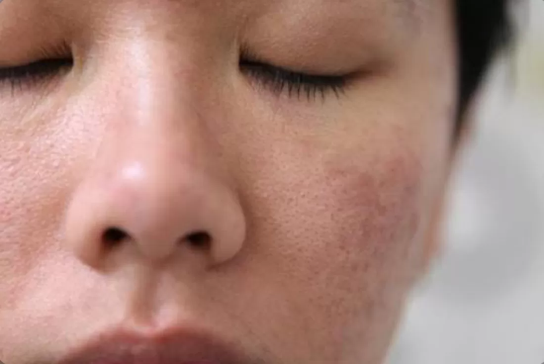 cara memperbaiki skin barrier yang rusak (freepik) (puspita)