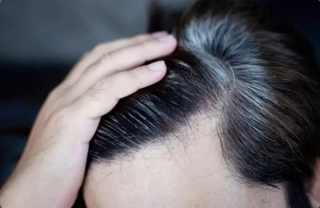 cara menghilangkan uban (freepik) (puspita)