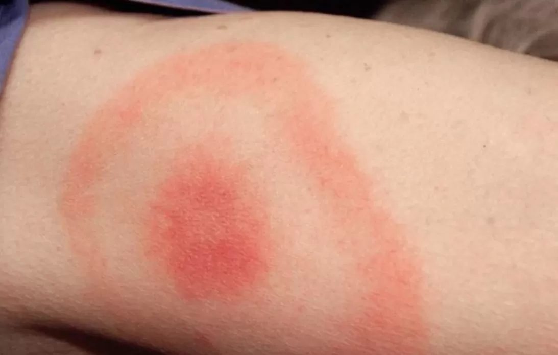 Bella Hadid Alami Penyakit Lyme, Ini Penjelasan  (puspita)