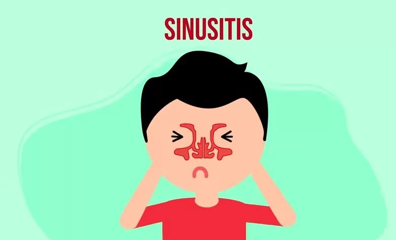 Mengenal Sinusitis: Gejala, Penyebab, Dan Solusi Dari Perspektif Dokter ...