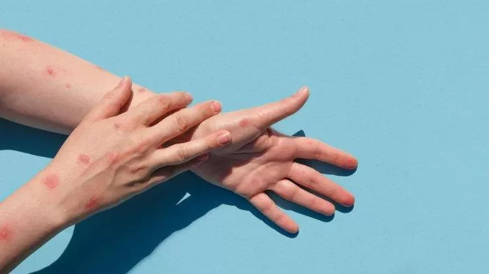 Ilustrasi penyakit cacar monyet. Foto: Tribunnews.com