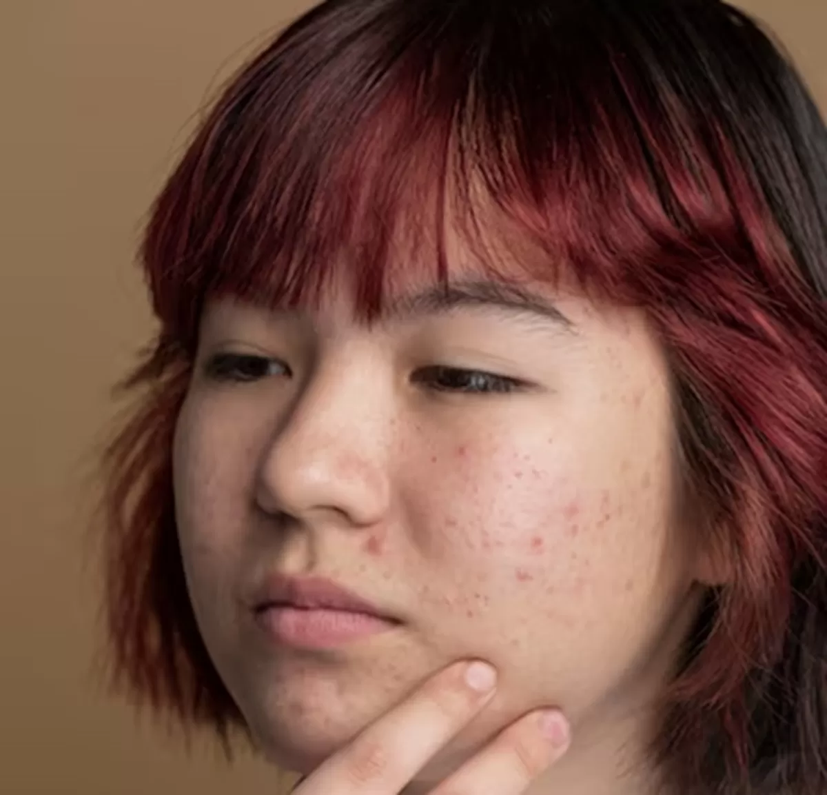 Apa itu PIE dan PIH pada Kulit?