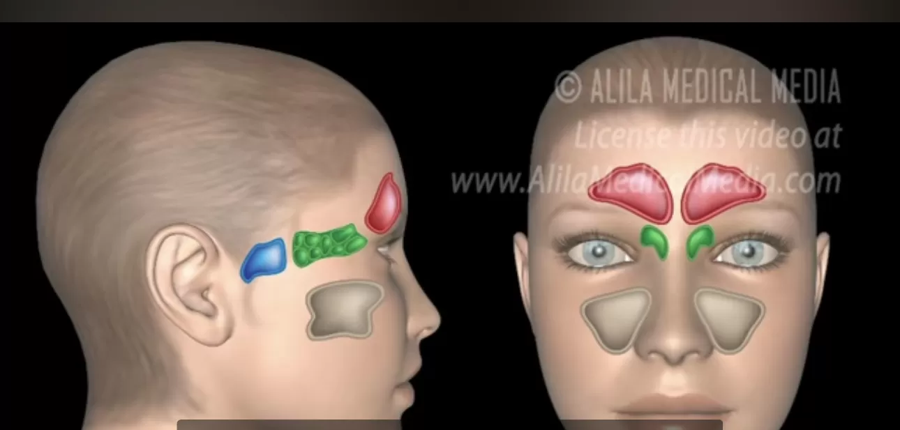 Mengenal Lebih Dalam Tentang Sinusitis,Penyebab, Gejala, Dan Cara ...