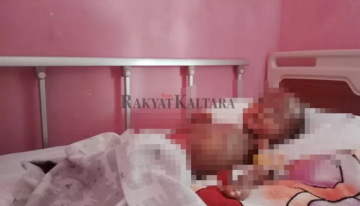 JALANI PERAWATAN: Azzam balita yang menderita Epidermolysis Bullosa mendapat perawatan intensif di BLUD Rumah Sakit Daerah (RSD) dr H Soemarno Sosroatmodjo Tanjung Selor.