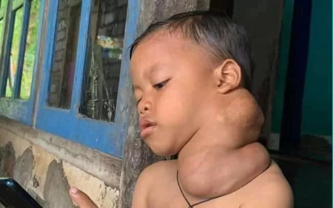 Foto : Juandi Risky Aditya menderita kanker kelenjar getah bening, dan harus dilanjutkan pengobatannya ke RS yang memang menyediakan pengobatan Kemoterapi untuk anak yakni di Bali